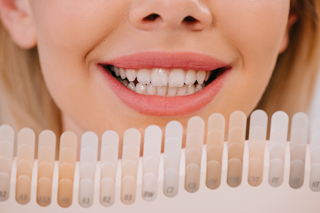 Signs it’s Time to Change Your Veneers