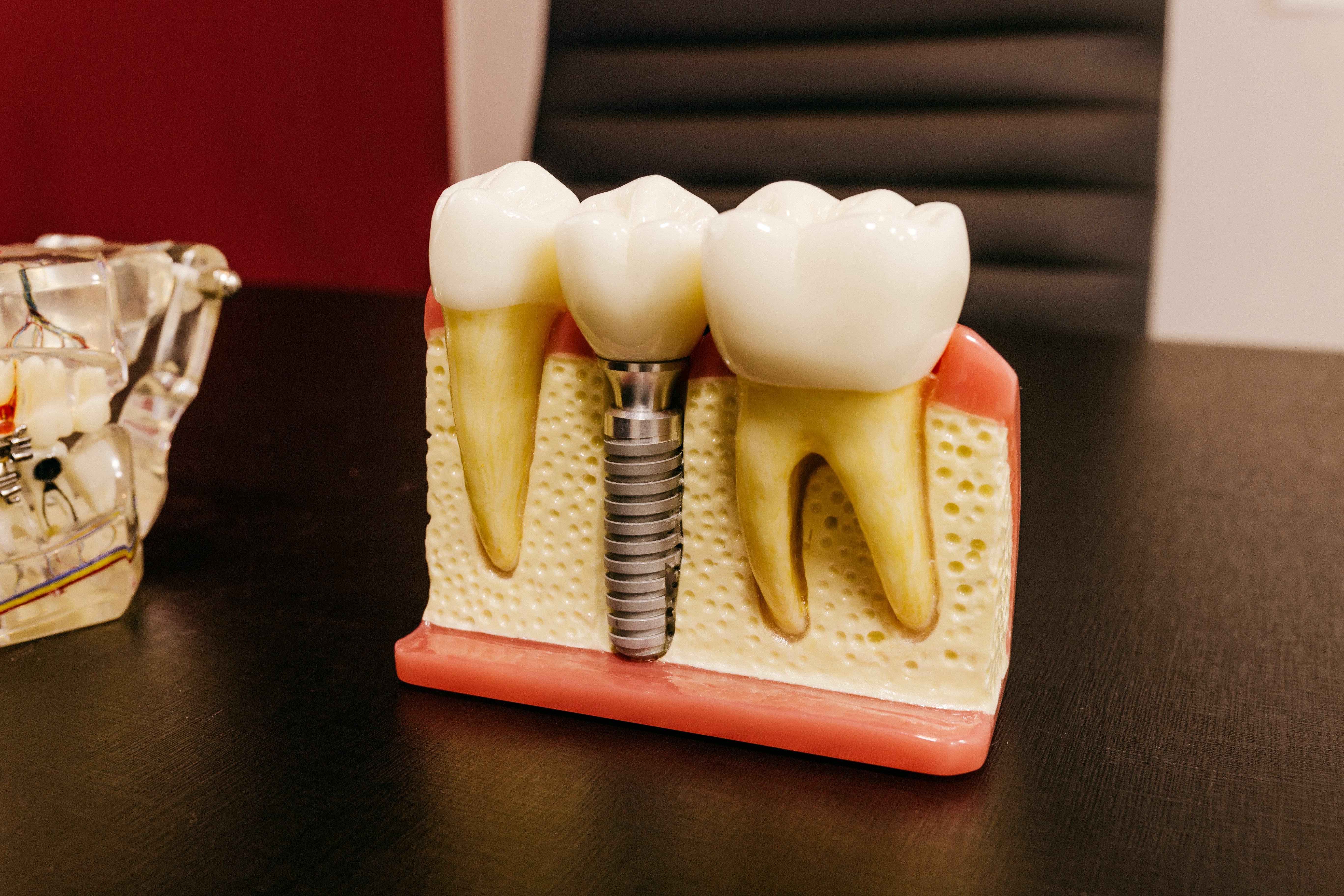 Dental Implants: Here’s What You Should Know!