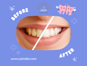 Treatment for teeth bleaching before and after
