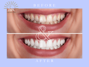 teeth bleaching before and after