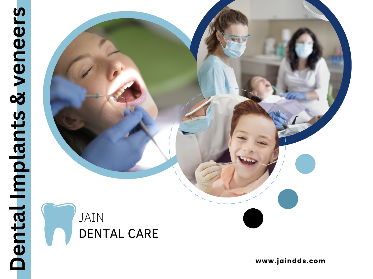 When to Choose Dental Implants Instead of Veneers?