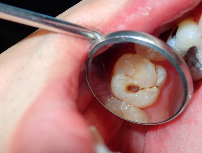 core filling - jain dental care