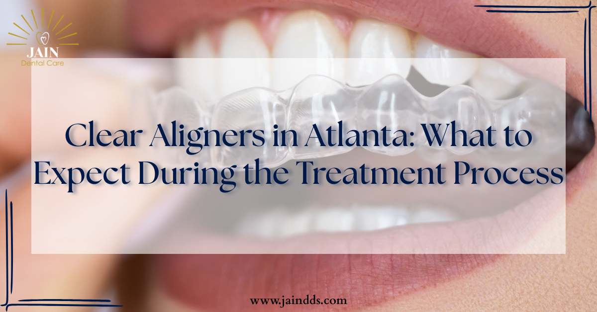 Clear Aligners in Atlanta: What to Expect During the Treatment Process