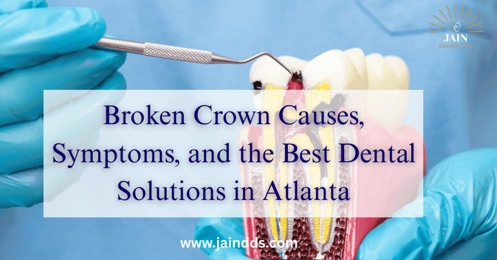 Broken Crown Causes, Symptoms, and the Best Dental Solutions in Atlanta