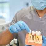 Are Dental Implants Worth It? Benefits, Costs, and What to Expect in Atlanta