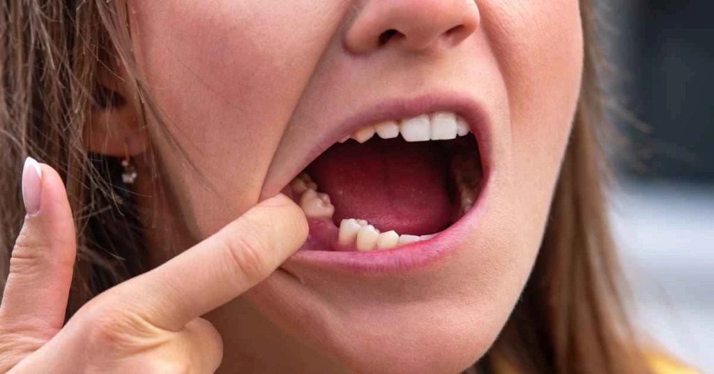 Missing Tooth Cause Bone Loss