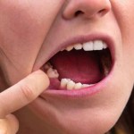 Can a Missing Tooth Cause Bone Loss? What You Should Know in Atlanta