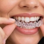Crowded Teeth in Atlanta? Can Clear Aligners Help Straighten Your Smile?